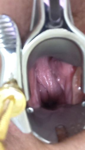 My Speculum Opens Me up