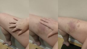 i love playing with my bruises and seeing the way the colours change when you poke them