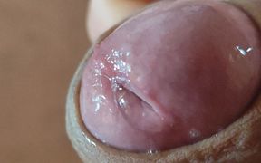 Deep Split in the Glans Produces Bubbling Liquid
