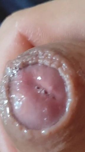 Deep Split in the Glans Produces Bubbling Liquid