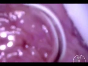 POV Endoscope Catheter Bladder Inflation!