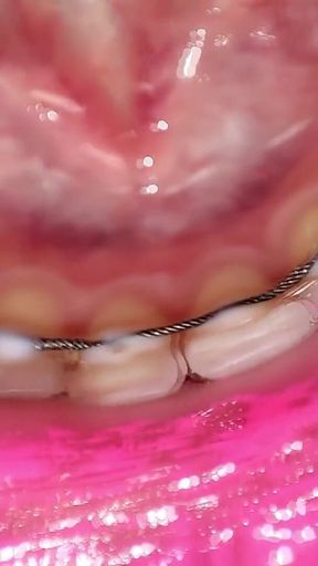 Permanent Retainers Mouth Tour