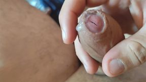 Dilation of the Corpus Cavernosum Exposes Spongy Foreskin.