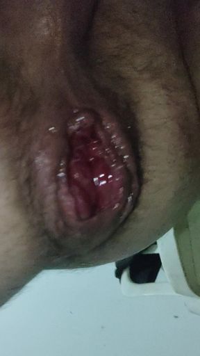 Scalded anal