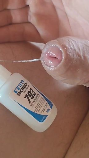 Homemade Self-adhesive Venous Pole Implant!!!