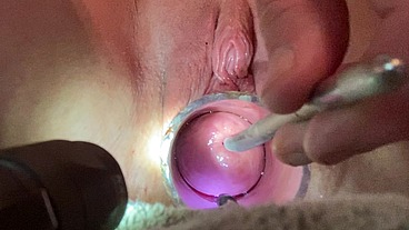 Frozen sound penetrates cervix with Tenaculum