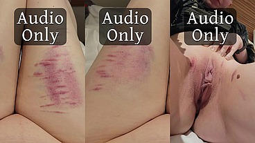 More pretty bruises and the story of how I got them