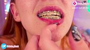 Messy Boogers and Braces
