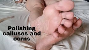 Polishing calluses and corns