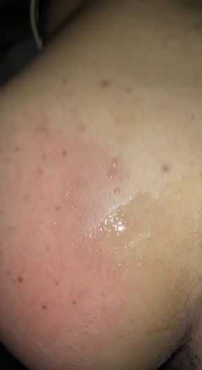 Close-up of a man's face with acne
