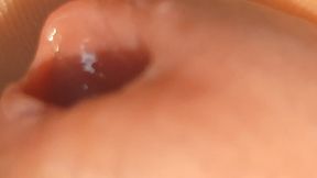 The Great Transformation of Phimosis Elastica.