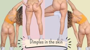 Dimples in the skin