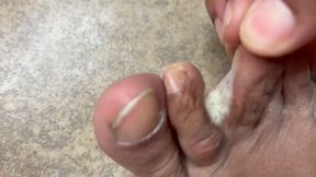 Picazón en mis pies