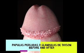 Tayson's glands or pearly papules