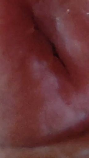 Dilation of the Glans Eye Has a Pleasant Surprise.