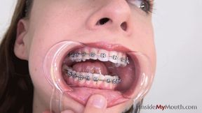 Inside My Mouth - Jennifer - Dental braces and mouth retractor! (4K quality)