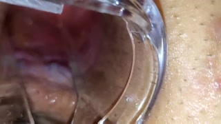 BBW extreme anal and asshole speculum gape