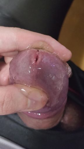 I injected gel made from my urine into my bladder