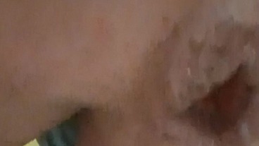 I jerk off my hemorrhoids and bring them to prolapse