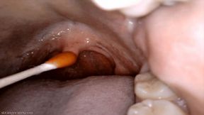 uvula cholula: direct hot sauce application with swab (720 wmv)