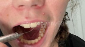 Sadistic Dental Cleaning with Explorer and Cavity Fillings 4K