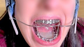 Braces HEADGEAR & HERBST cum in mouth