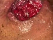 Anal Fisting And Prolapse TEASER