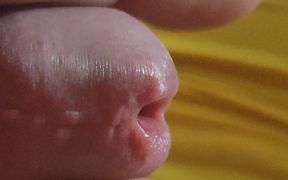 Scarred Frenulum Causes Glans Erection!