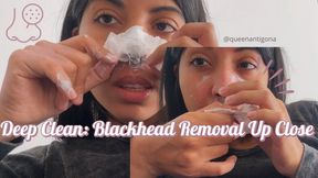 Deep Clean: Blackhead Removal Up Close